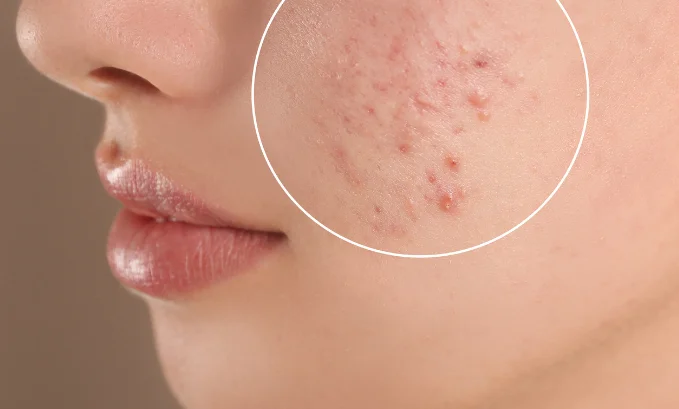 does glp 1 cause acne Exploring the Impact of Tirzepatide on Acne