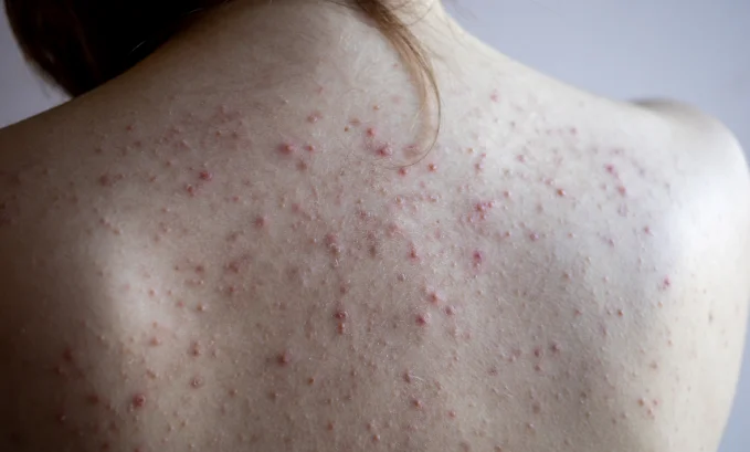 does glp 1 cause acne Exploring the Impact of Tirzepatide on Acne