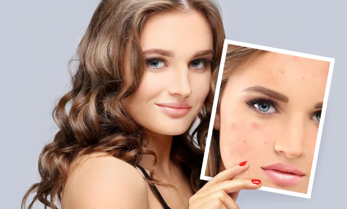 tirzepatide acne Exploring the Impact of Tirzepatide on Acne